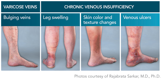 Why Are Women More Susceptible to Varicose Veins?